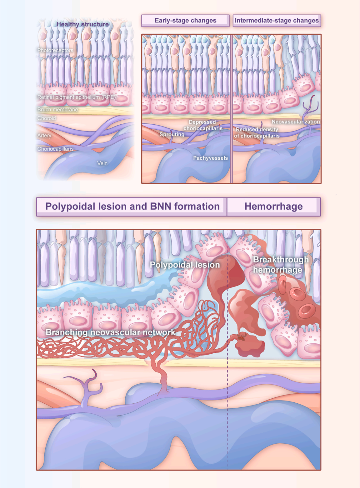 临床研究成果｜北京协和医院陈有信教授团队全面解析息肉状脉络膜血管病变