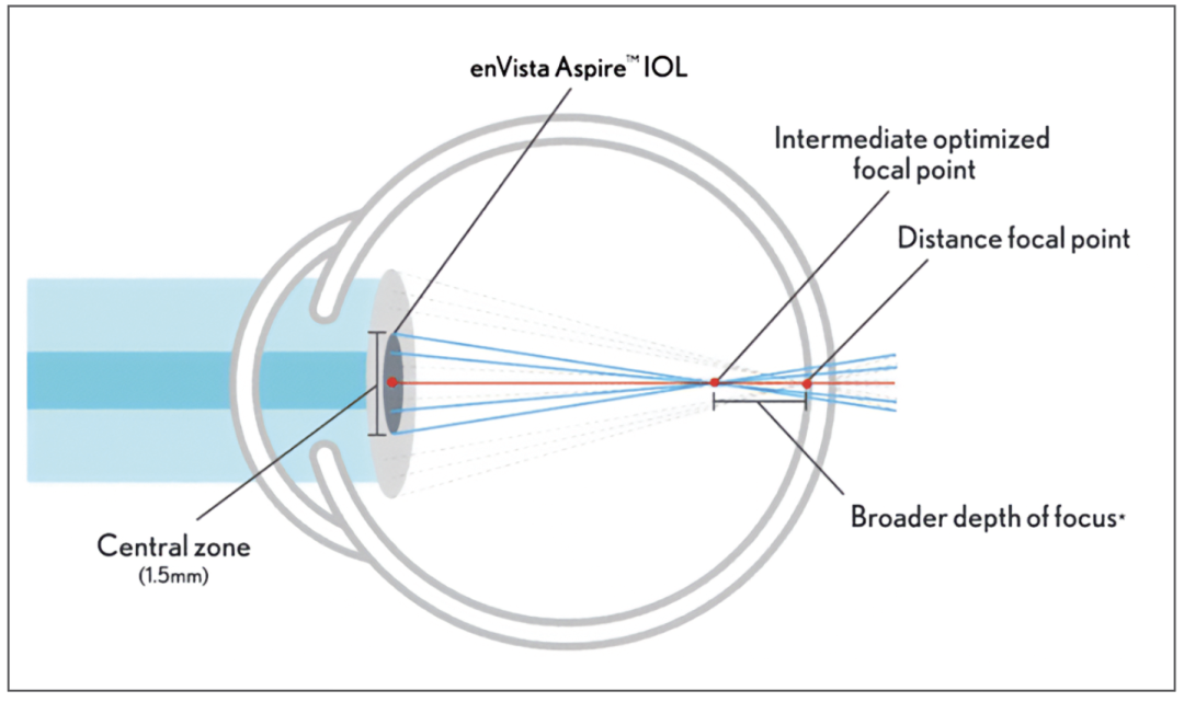 人工晶状体光学设计新时代的探索