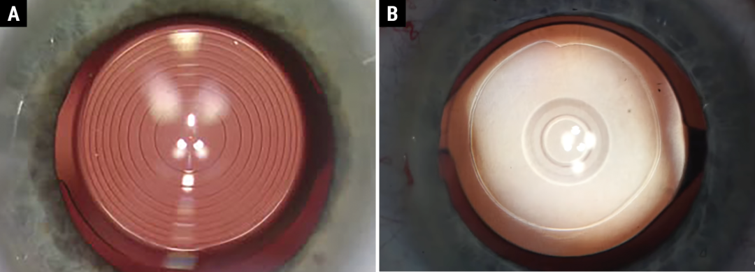 人工晶状体光学设计新时代的探索