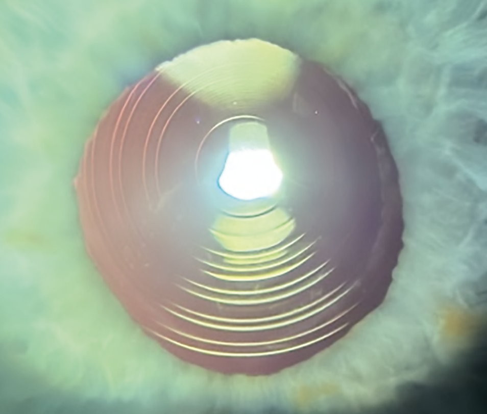 人工晶状体光学设计新时代的探索