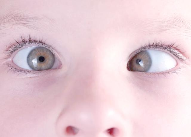 麻痹性斜视与限制性斜视的临床鉴别要点与诊疗策略