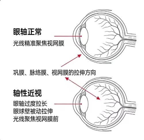 屈光异常与阿尔茨海默病：视网膜神经纤维层厚度的“预警价值”
